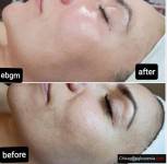 Mezoterapia Frakcyjna  