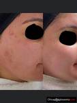 Mezoterapia Frakcyjna