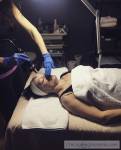 CRYO FACIAL/ KOTOX