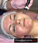 MEZOTERAPIA Microiglowa CIT - Collagen Induction Therapy